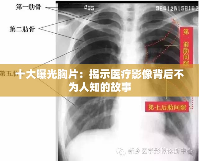 十大曝光胸片：揭示医疗影像背后不为人知的故事