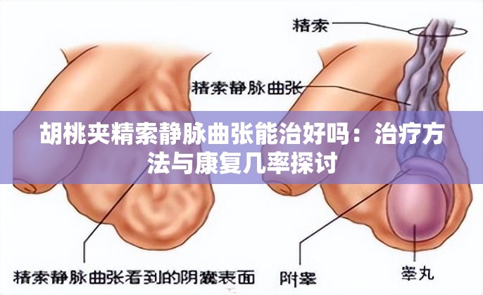 胡桃夹精索静脉曲张能治好吗：治疗方法与康复几率探讨
